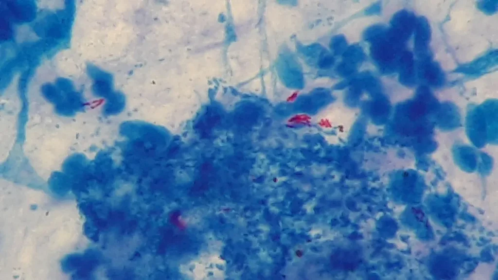 Mycobacterium tuberculosis bacteria seen in a stained sputum sample under a microscope